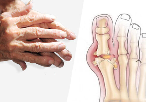 Jak leczyć artretyzm? kilka wskazówek