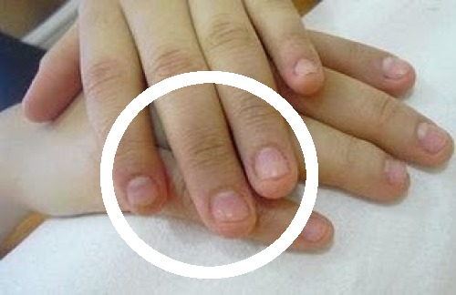 Obgryzanie paznokci — wskazówki jak przestać