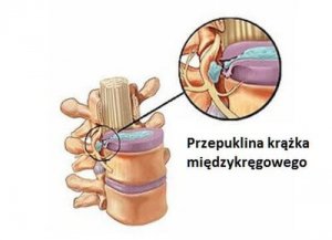 Przepuklina kręgosłupa, czyli wypadający dysk