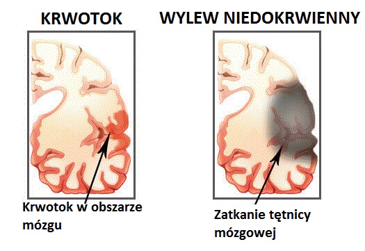 2#:udaru.mózgu.jpg