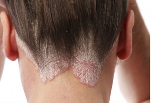 Łupież i łojotok – Pozbądź się naturalnymi sposobami