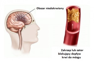 Udar mózgu u kobiet ― czynniki ryzyka