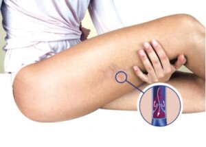 Zwalczamy żylaki naturalnymi sposobami