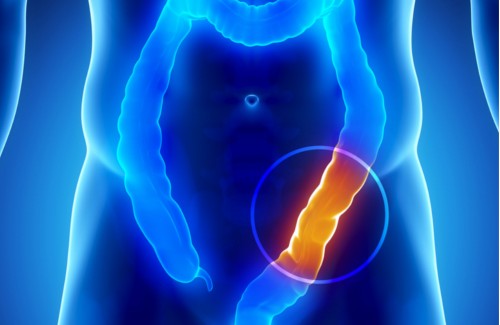 Nowotwór okrężnicy