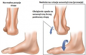Dbaj o pięty - pozbądź się złych nawyków