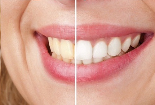 Wybielanie zębów to jeden z chorobliwych nawyków