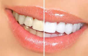 Marzą Ci się białe zęby? Unikaj tych produktów!