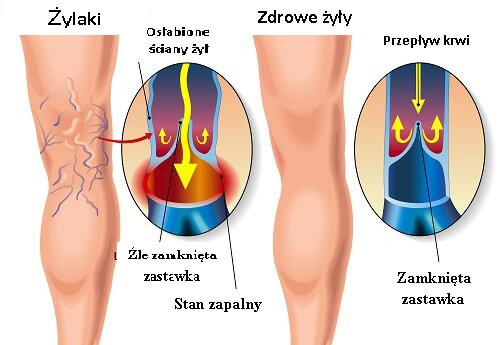 Zdrowe żyły i żylaki