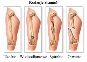 Pierwotny nowotwór kości — wiesz jak go rozpoznać?