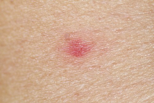 ukąszenie i rany na skórze
