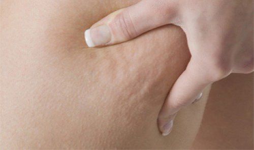 cellulit Cellulit zwalcz go naparami