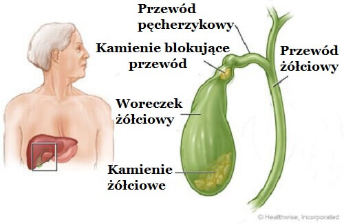 Kamienie żółciowe - główne symptomy