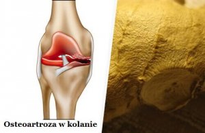 Osteoartroza – Walcz z jej symptomami!