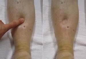 Obrzęk – najważniejsze informacje