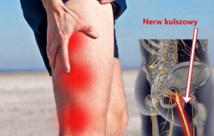 Rwa kulszowa – naturalne sposoby na łagodzenie bólu