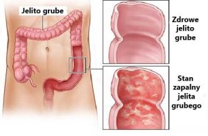 Wrzodziejące zapalenie jelita grubego – zwalcz je