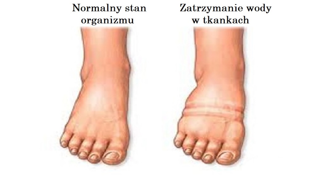 Objawy zatrzymania wody w tkankach