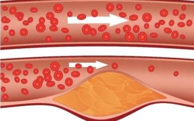 Cholesterol w naczyniach krwionośnych