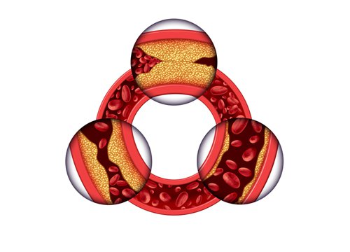 Cholesterol w tętnicach