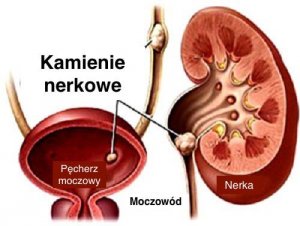 Kamienie nerkowe - 6 produktów, które mogą je wywołać