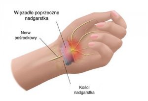 Zespół cieśni nadgarstka - uporaj się z bólem