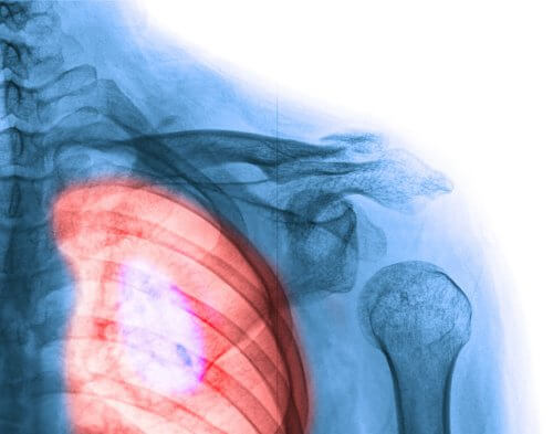 Rak płuc — objawy, które powinieneś znać!