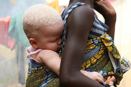 albinizm w Afryce