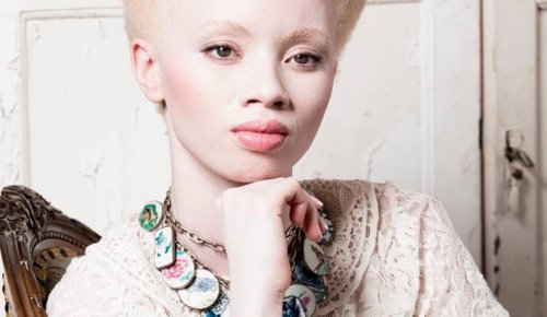 Albinizm: poruszająca historia modelki