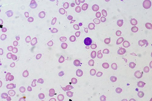 Anemia