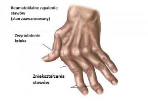 Artretyzm w dłoniach - 7 naturalnych leków