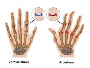 Artretyzm - 7 niezbędnych zasad