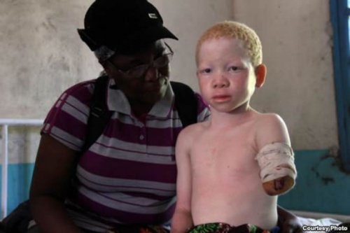 brak kończyny u albinosa