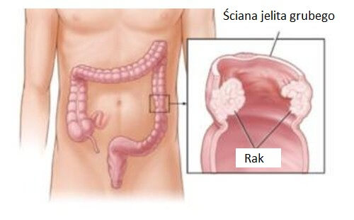 Rak jelita grubego – jak go uniknąć? Rak jelita grubego – jak go uniknąć?