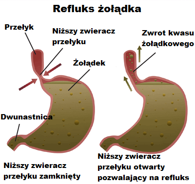 Refluks żołądka