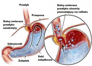 Sposoby na refluks i zgagę