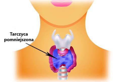 Tarczyca - niedoczynność
