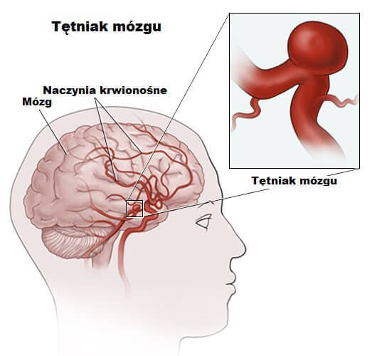 Schemat przedstawiający rozwijające się tętniaki w mózgu
