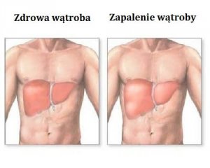 Zapalenie wątroby: symptomy i dieta