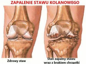 Zapalenie stawów – objawy i profilaktyka