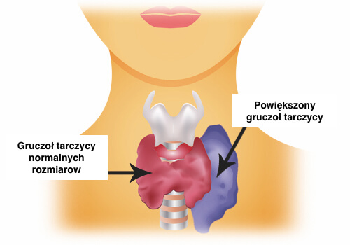 Nadczynność tarczycy