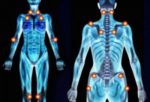 Fibromialgia – łagodzenie objawów ziołami