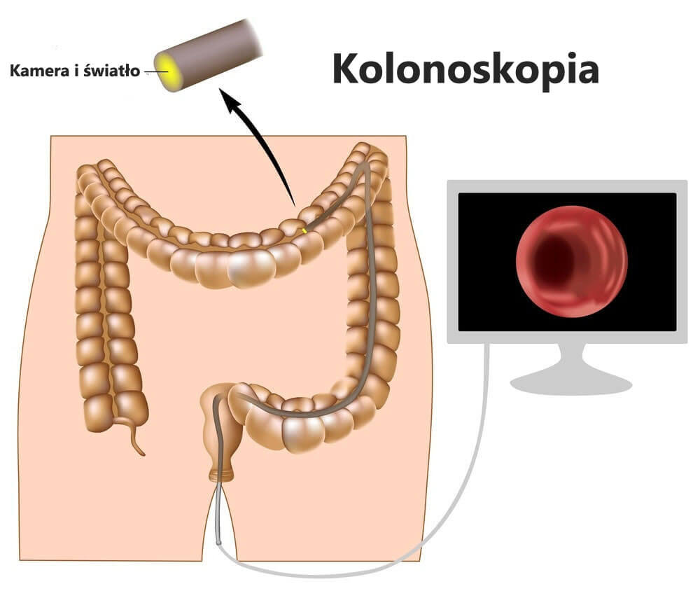Kolonoskopia - badanie okrężnicy