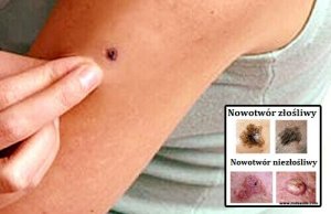 Nowotwór skóry: niepokojące objawy