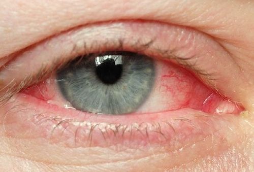 Podrażnione oczy? – Naturalne leczenie Podrażnione oczy? – Naturalne leczenie