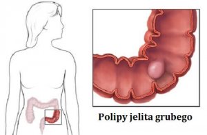 Polipy jelita grubego - Co należy wiedzieć?
