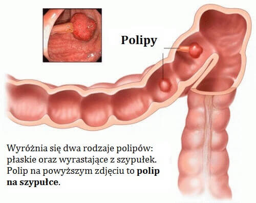 Polipy w okrężnicy