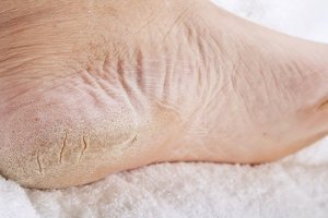 Popękane pięty? – Naturalna pielęgnacja