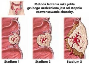 Rak jelita grubego - co należy o nim wiedzieć?