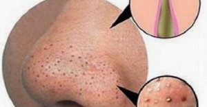 Wągry i zaskórniki - jak naturalnie je usunąć?