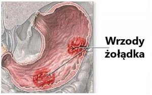 Wrzody żołądka – typowe objawy